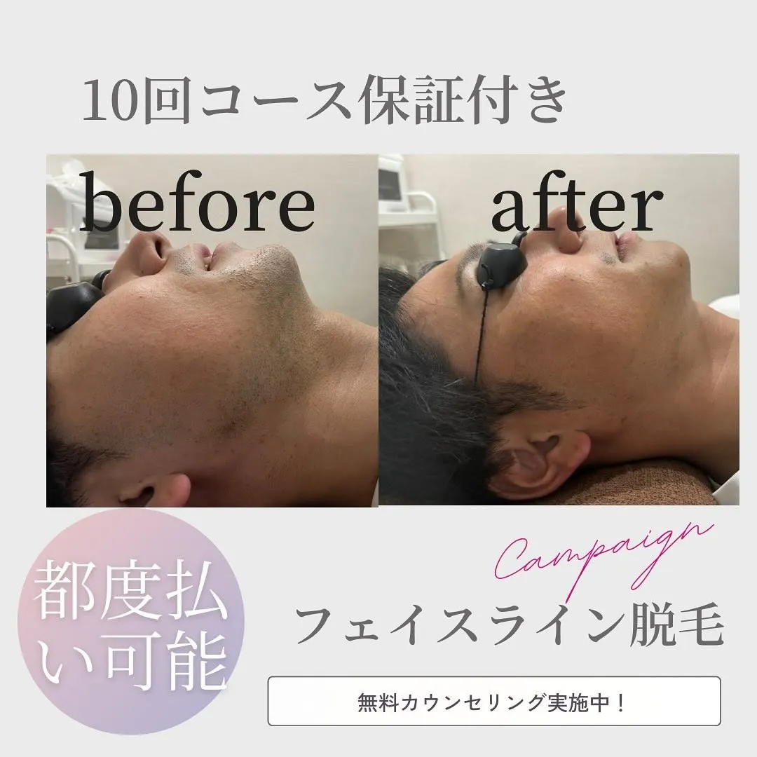 フェイスライン脱毛10回目のお客様