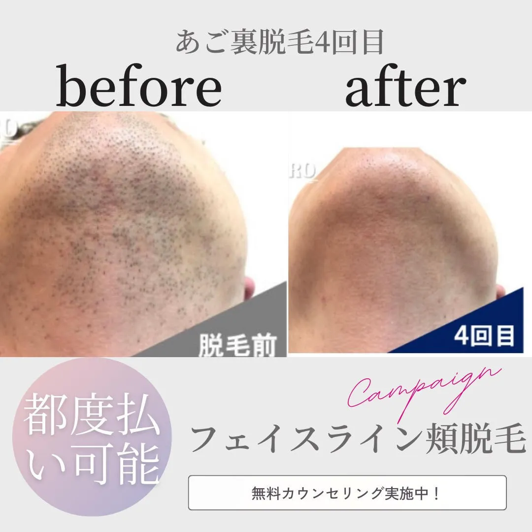 膝下脱毛4回目のお客様