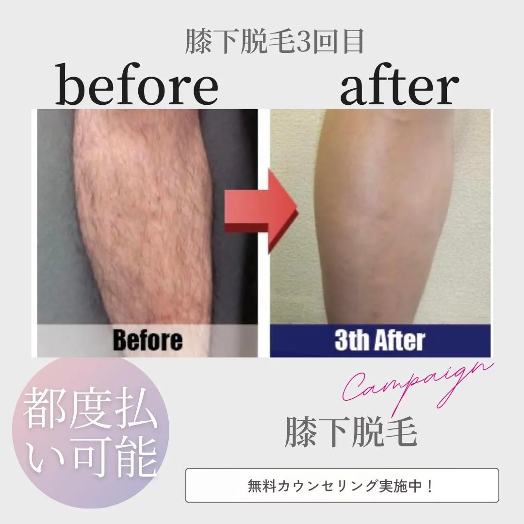 膝下脱毛3回目のお客様